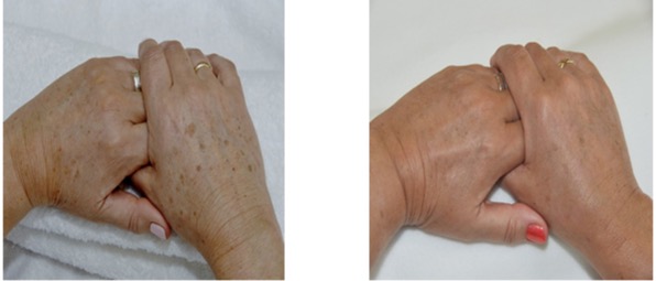 Pigmentation, sun spots